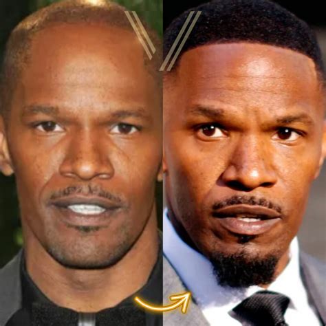 Jamie Foxx Hair Transplant: Before and After Transformation