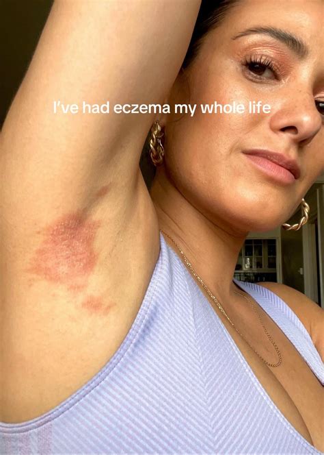 Armpit Rashpictures Causesfungi Heat Treatment