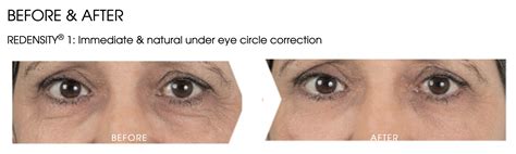 Redensity | Mon Visage Health