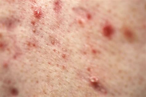 Fighting Acne and Skin Breakouts During Chemotherapy: A Comprehensive ...