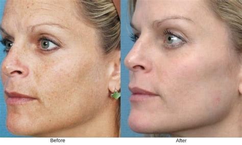 BBL Photofacial in Fairfield County | Westport & New Canaan
