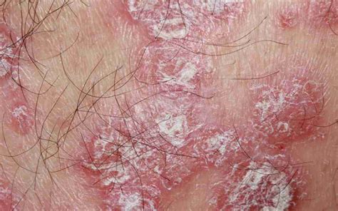 jenis penyakit  kulit   terjadi  penyebabnya