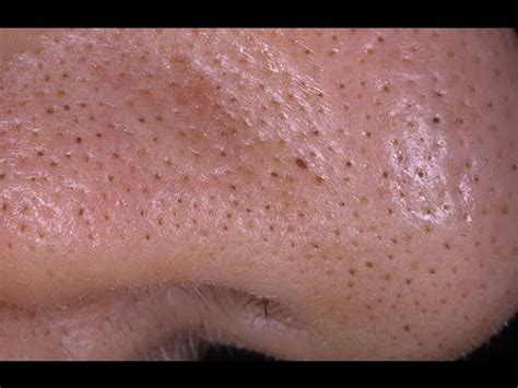 Выдавливание черных точек, угрей на носу/Nose Blackheads Squeezing ...
