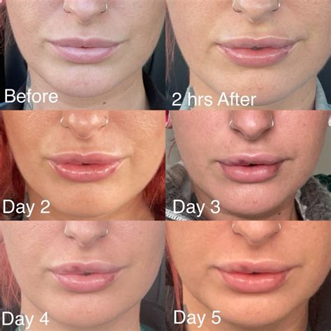 botox  reduce wrinkles creases  fine lines regenix