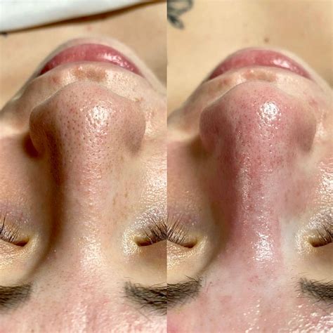 extractions facial extractions facial    celebrity