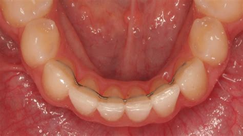 Plastic Vs. Metal Retainers: Which One Is Better?