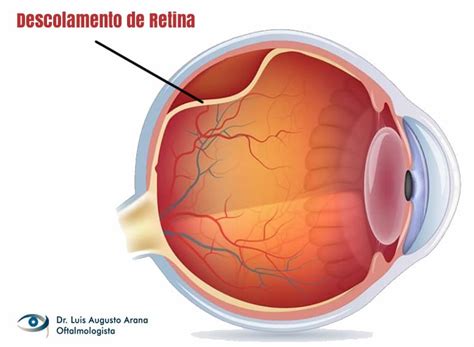 O Que E Deslocamento De Retina - Descolamento de retina: Saiba o que é e onde realizar o tratamento em ...