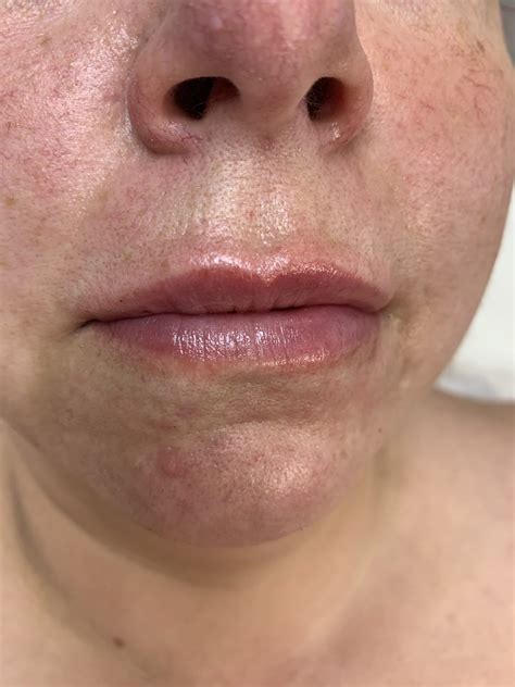 marionette lines clinic  colchesters leading aesthetics clinic