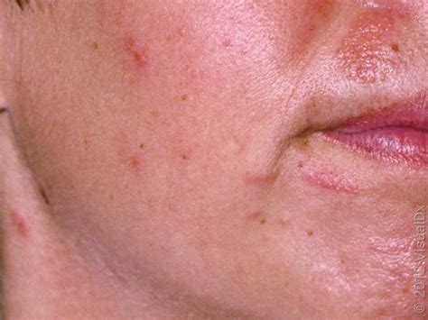 Contact Dermatitis Face Treatment