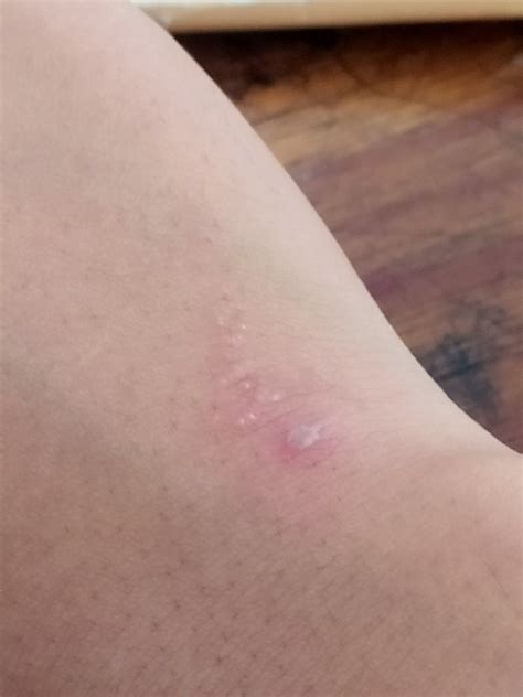 merah   nanah  kulit hellosehat