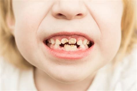 4,389 Bad Teeth Kids Images, Stock Photos, 3D objects, & Vectors ...