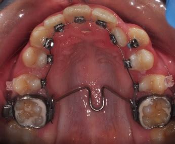 Лечение с Pendulum и лингвални брекети — Oртодонтска клиника GreOrtho ...