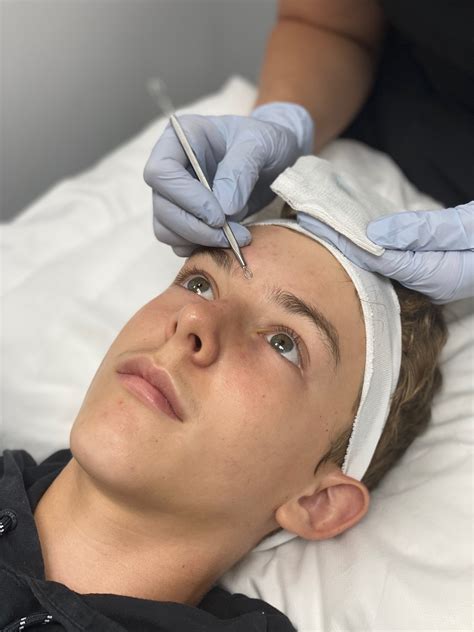 This Unbelievable Blackhead Removal 2024 Treatment Will Leave You Speechless! Image 19