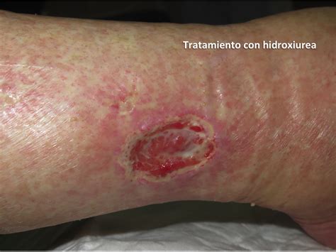 VHJhdGFtaWVudG8gY29uIGhpZHJveGl1cmVh - Elena Conde