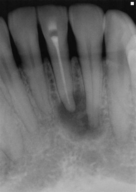 Radiograph showing adequately filled Root canal of mandibular left ...