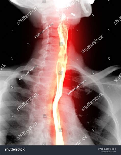 Barium Swallow Study Test Diagnose Barretts Stock Illustration