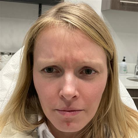 Neurotoxin Before & Afters | Pura Vida Medspa & Cosmetic Laser Center