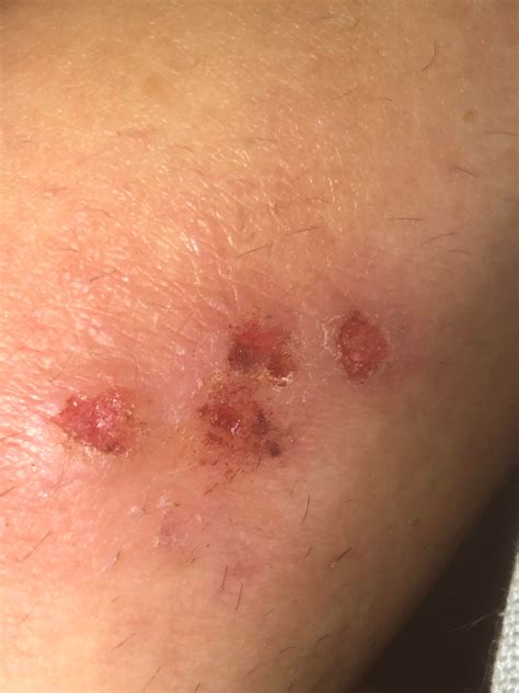 Folliculitis or atopic dermatitis??? : r/Folliculitis