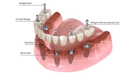 All On 6 Dental Implants Cost Mexico by Dr. Jose Moguel DDS