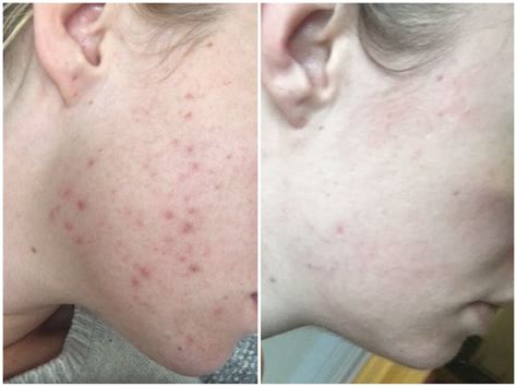 Mild Acne - Andy Millward - Facialist