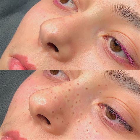 pecas tatuadas como es el procedimiento  cuanto dura