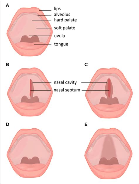 Cleft Palate Types