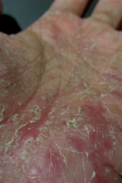What Is Dyshidrotic Eczema How To Identify And Treat - vrogue.co