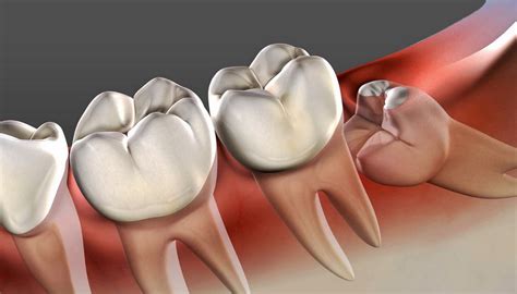 ProDental Centar | Dežurni stomatolog | Ispravljanje zuba