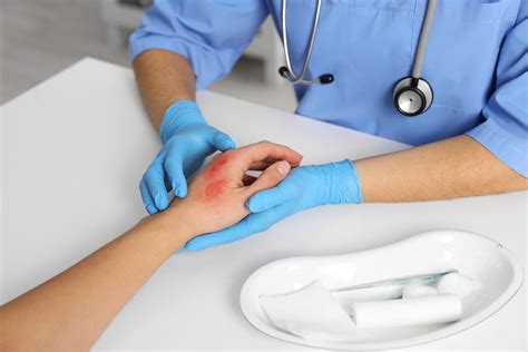 Burn Injury Lawyer