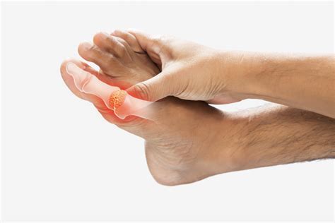 Hyperuricemia: Causes, Symptoms, and Natural Solutions - Alternative ...