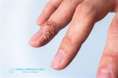 Alergia A Gel De Unha - Alergia a esmalte de unha. – Alergia Botafogo – Alergistas Rio de Janeiro