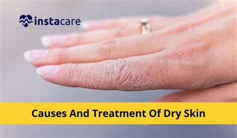 Causes And Treatment Of Dry Skin
