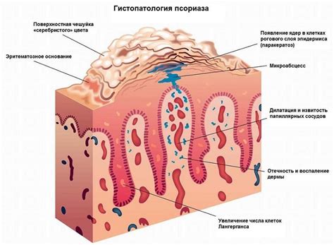 Псориаз - причины, симптомы, методы лечения. Медицинский центр "Медюнион"