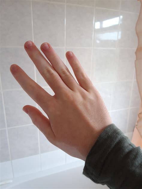 309 best r/vitiligo images on Pholder | Continuing to love my patterns