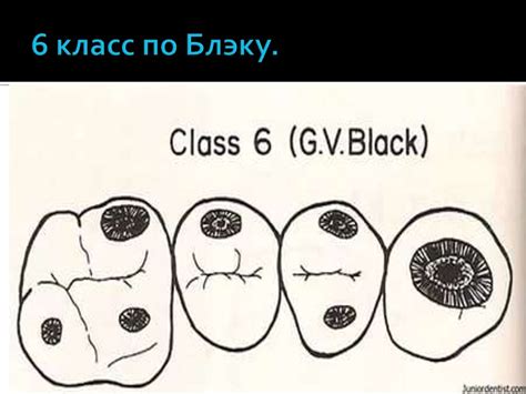 Стадии кариеса: меловое пятно, пигментированное, поверхностный кариес ...