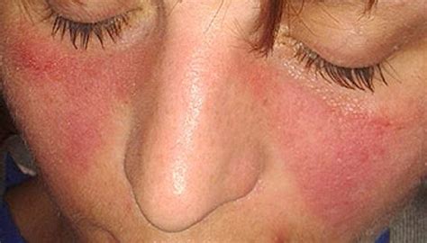 lupus  symptoms  research