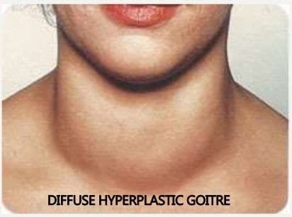 GOITER - New