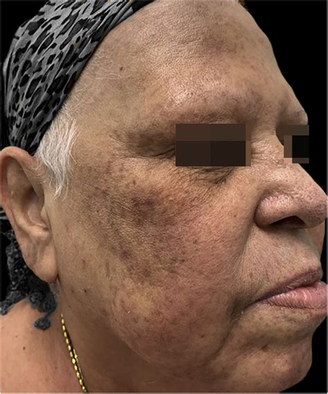Acute localized exanthematous pustulosis induced by paclitaxel | Anais