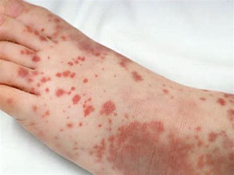 Diabetic Dermopathy: Causes, Symptoms & Treatment - Boldsky.com