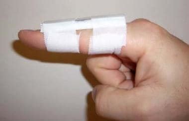 Reduction of Finger Dislocation Technique: Approach Considerations ...