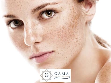 Пигментни петна по кожата | Gama Cosmetic