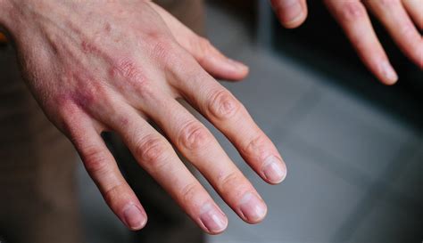 caring  dry cracked hands  pure