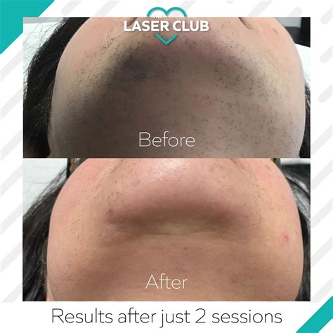 Laser Hair Removal Face Not Working at Allen Long blog