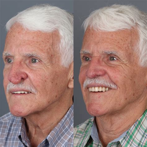 Patient 123046239 | Rhinophyma Gallery | Vila Facial Plastic Surgery