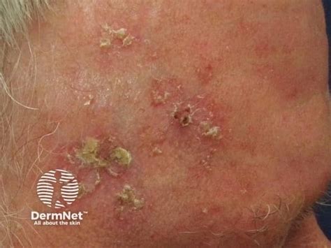 actinic keratosis