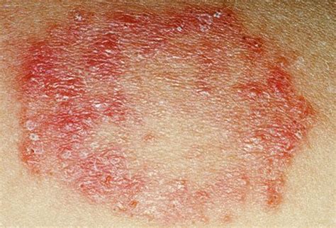 skin infection cozmoderm clinic  dermatology clinic  skin