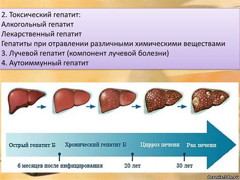 Гепатит - презентация онлайн