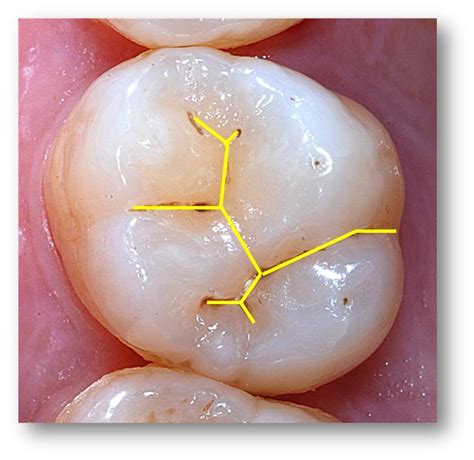 oral biology posterior tooth anatomy upper st molar
