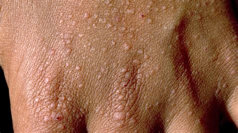 Follicular Eczema: Understanding the Causes, Symptoms, and Treatment ...