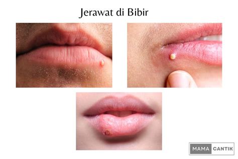 jerawat  bibir arti penyebab   menghilangkan